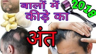 100 Working Home Remedy for Alopecia  Alopecia Areata natural treatment  Baldness [upl. by Sucrad]