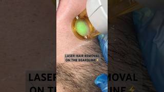 Laser hair removal on the beardline ⚡️ [upl. by Nwavahs]