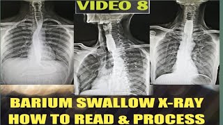 Barium Swallow Test  Barium Swallow Procedure [upl. by Yentyrb]