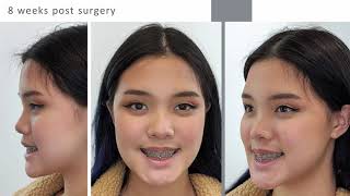 What to expect from corrective jaw surgery experience [upl. by Feer]