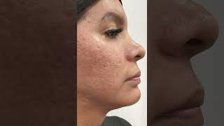 Testimonio Peeling de Fenol [upl. by Lertnek833]