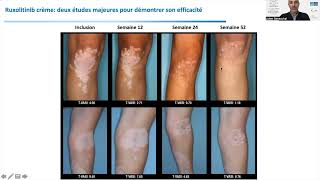 Ruxolitinib en crème un nouvel espoir pour le Vitiligo [upl. by Skillern]