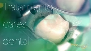 Tratamiento caries dental [upl. by Ain]