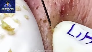 Simply Popping Clogged Pores In Skin Sebum Extraction From Patient Blackheads and Cystic Pockets [upl. by Dita654]