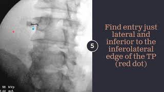 2 Minute Lumbar Transforaminal Epidural Injection [upl. by Haras188]