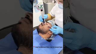 Treatment for acne pits and scarsmicro needling therapy skincare shorts viral drrichadubey [upl. by Rockefeller21]