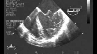 infective endocarditisTEE chordal rupture of both leaflets of the mitral valve [upl. by Eronel880]