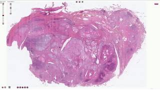 Hashimoto Thyroiditis  Histopathology [upl. by Adohr]