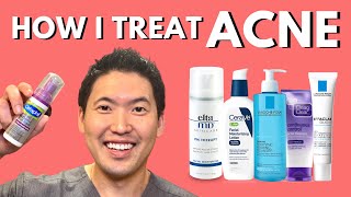 How I Treat Acne An Overview of Treatment Options [upl. by Erlond]