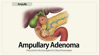 Ampullary Adenoma or T1 Ampullary Adenocarcinoma [upl. by Siuqcram]