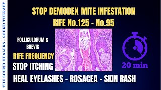 DEMODEX ➤ Stop Itching ➤ Mite Infestation ➤ Heal Eyelashes ➤ Dermatitis ➤ Skin Rash ➤ Sound Therapy [upl. by Ariik556]