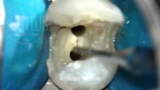 Microsonic in Endodontics [upl. by Kit]