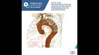 Espacio para profesionales  Disección aórtica tipo B tratada con endoprótesis Control por TC 3D [upl. by Nylakcaj]