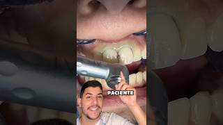 Veja como é feita a restauração de um dente anterior 💎 dentes curiosidades dentista odonto [upl. by Matlick852]