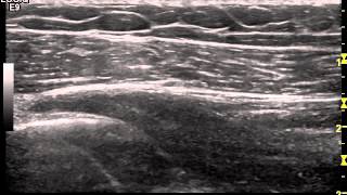 Ultrasound guided hydrodistension of the glenohumeral joint  Dr Peter Resteghini [upl. by Selhorst700]