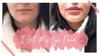 I GOT LIP FILLERS  Getting 1ml of Juvederm Volift  beckyloubutton [upl. by Viveca]