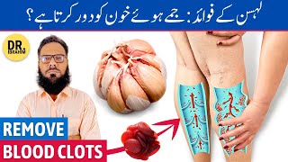 Lahsun Ke Fayde  Remove Blood Clots in Legs  Garlic Benefits  UrduHindi  Dr Ibrahim [upl. by Rokach]