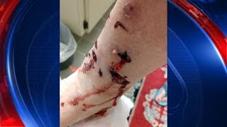 Raccoon attacks Tampa woman [upl. by Arec664]