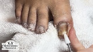 Fix Thick and Discolored Toenails nails satisfying [upl. by Harol]