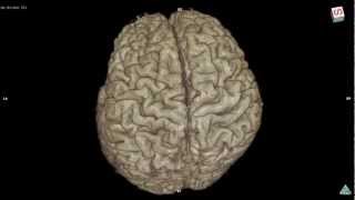 Variation of brain cortex 3D MRI sample Bgo [upl. by Anifled]