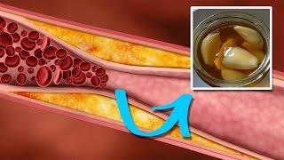 How to Lower Triglycerides Quickly and Naturally [upl. by Anihpesoj]