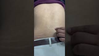 Dryneedling therapy for back pain dryneedling ytshorts backpain physiotheraphy terenaina [upl. by Ycam546]