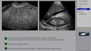 Ultrasound of the Liver HCC 1 in Arabic أورام الكبد [upl. by Meeka]