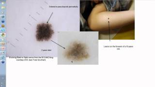 Dermoscopy Made Simple  Reed nevus [upl. by Hastings]