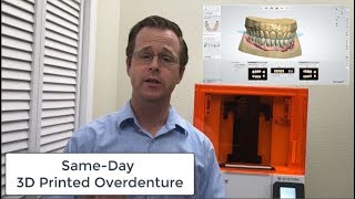 SameDay 3D Printed LOCATOR Overdenture [upl. by Kenwrick]