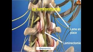 laminectomie lombaire [upl. by Tillford285]