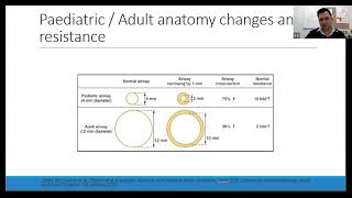 Acquired Paediatric Subglottic Stenosis  Dr Suraj Gaire [upl. by Ariam]