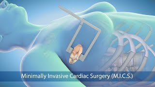 Medical Animation Minimally Invasive Cardiac Surgery MICS at Sarasota Memorial Hospital [upl. by Jew]