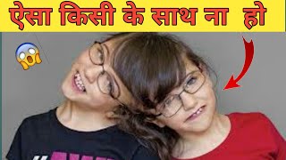 ऐसा किसी के साथ नाहो  conjoined twins  Tatiana and Krista Hogan [upl. by Mcgaw]