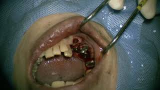 Straumann NC RN WN place in posterior mandible 4 [upl. by Issor6]