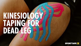 Kinesiology Taping for Dead Leg  How To Use Kinesiology Tape to Reduce Swelling amp Haematoma [upl. by Alyam302]