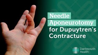 Needle Aponeurotomy for Dupuytrens Contracture [upl. by Rutherford992]