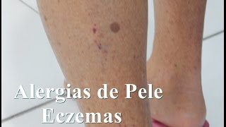 Dicas para Eczemas  Alergias na Pele [upl. by Dowzall]