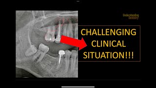 How to solve this clinical case OPG interpretation radiology radiographic interpretation x ray [upl. by Bergman325]