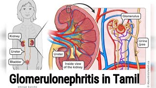 Glomerulonephritis in Tamil [upl. by Arundell]