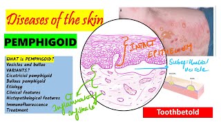 Pemphigoid Causes pathogenesis Types Histopathology Treatment  Pemphigus vs Pemphigoid [upl. by Lapo402]