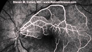 Central Retinal Artery Occlusion with Cilioretinal Artery Sparing  Fluorescein Angiogram Video [upl. by Pierre]