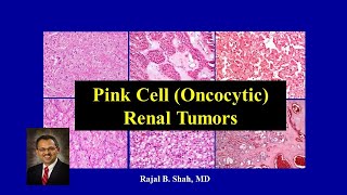 A Dummies Guide to Pink Cell Oncocytic Renal Tumors [upl. by Eillim]