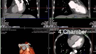 Coronary CT Angiography RCA Stenosis [upl. by Lleksah]