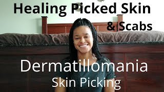 Healing Picked Skin amp Scabs  Dermatillomania [upl. by Medorra351]