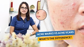 Acne marks Vs Acne scars what is the difference  Dr Deepika Lunawat [upl. by Silden]