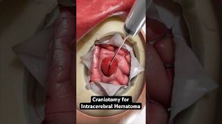 Removing pooled blood from the brain 3D Animation [upl. by Ciredec225]