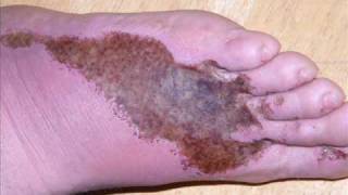 FOOT Picture Cellulitis  Rattle my cage Rehab [upl. by Brieta]