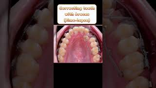 Correcting teeth with braces timelapse teethbraces orthodontics shorts [upl. by Sand]