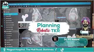 Cuvis Joint Robotic System shows the patient’s bone in 3D CT images for preplanning of surgery [upl. by Helsell]