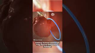 Endoloop Assisted Colonoscopic Polyp Removal Polypectomy Technique [upl. by Durer]